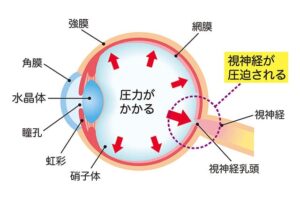 視神経が圧迫される