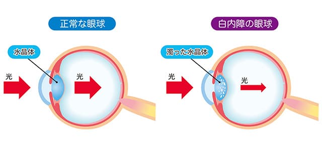 白内障について