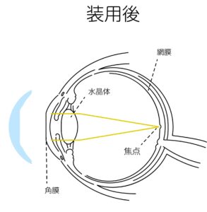 装用後